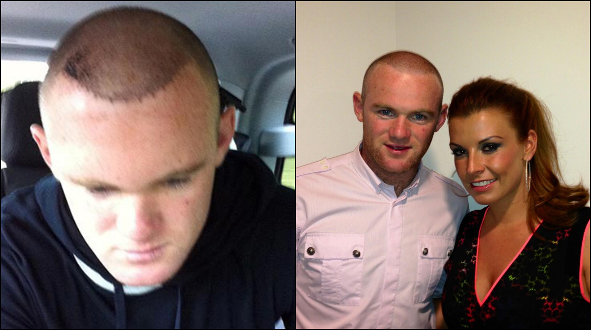 Manchester United, Wayne Rooney, Hårtransplantation