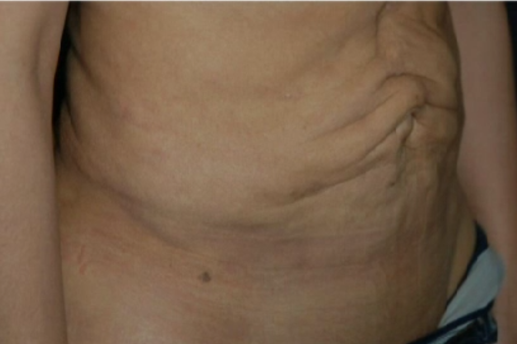 Laser, Skönhetsindustrin, Botox, Fettsugning