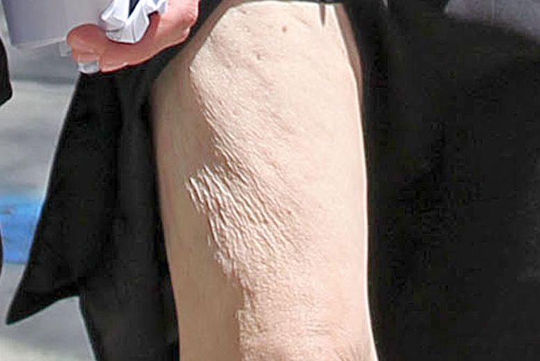 Celluliter, Kändisar