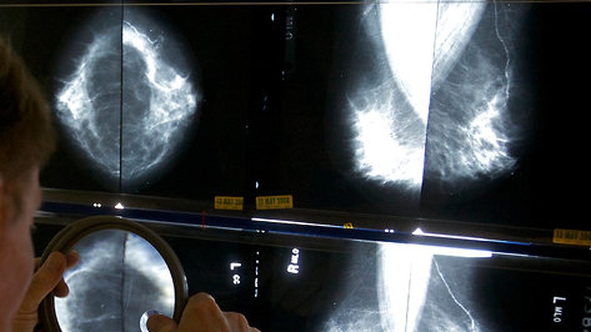 Ett tecken på bröstcancer är när man hittar en knöl i bröstet – men ibland kan knölarna vara godartade. 