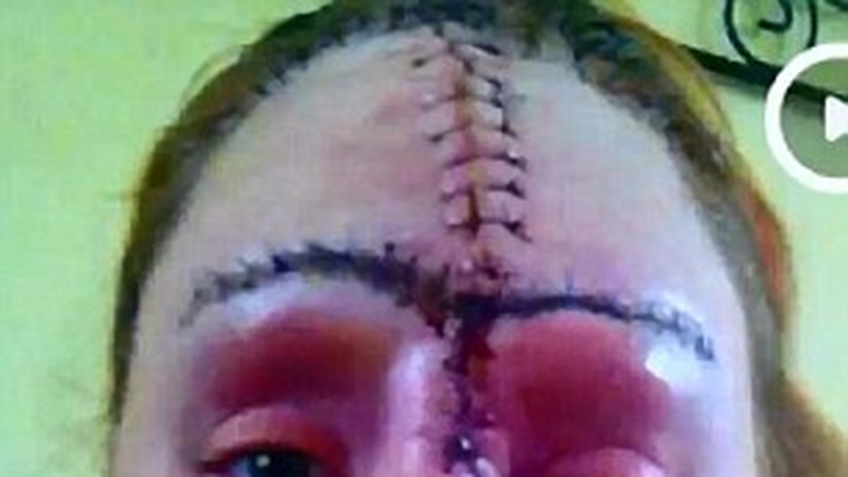 Hon har genomgått flera operationer efter att ansiktet exploderade.