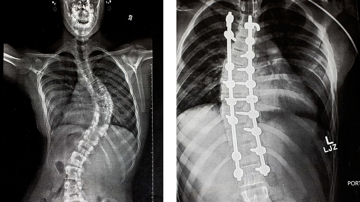 Till vänster är hur hennes ryggrad såg ut från början – till höger hur den till slut blev.
