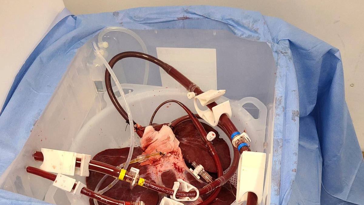 Kirurger i USA har lyckats ansluta en grislever till en hjärndöd man och sett blodet cirkulera. Bilden visar grislevern innan den användes i försöket som ägde rum i december.