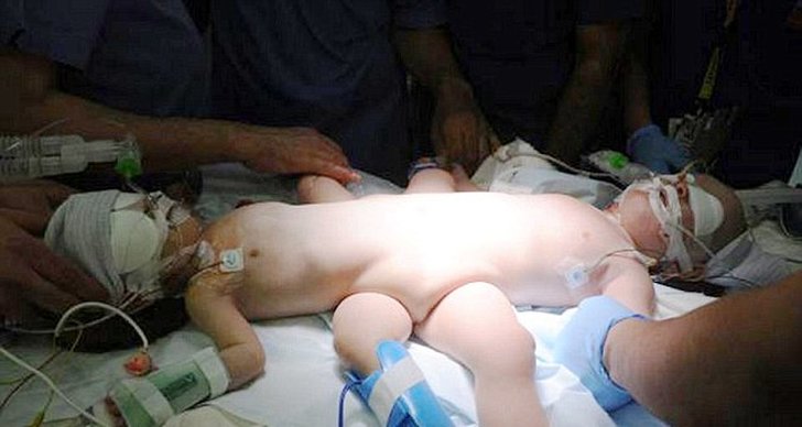 Operation, Siamesiska tvillingar, Bild, Saudiarabien