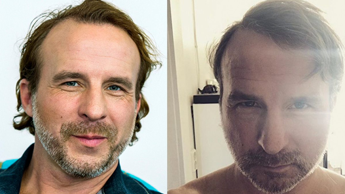 Artisten Patrik Isaksson har gjort en hårtransplantation. 
