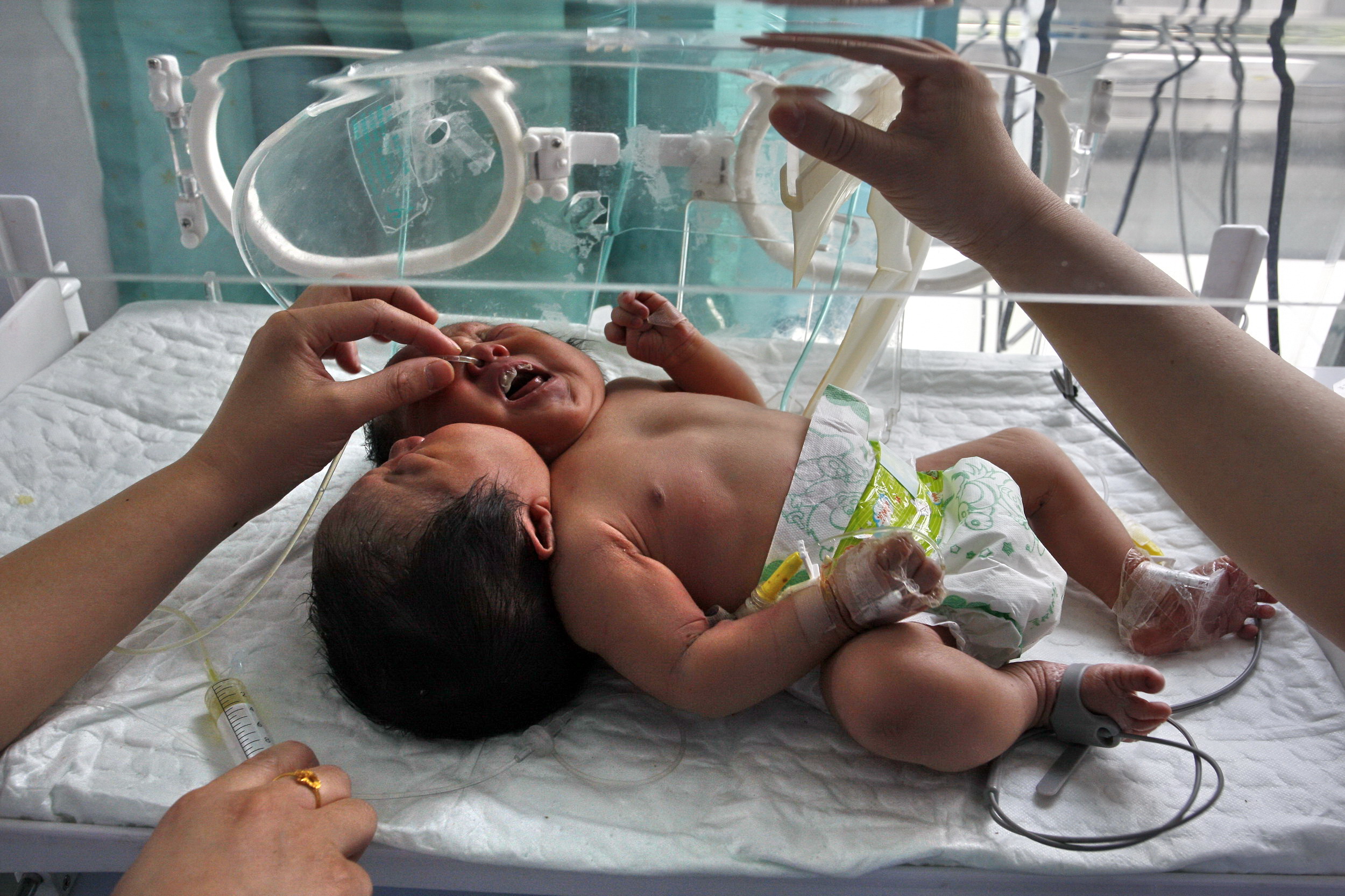 Siamesiska tvillingar, Kina, sjukhus, Barn
