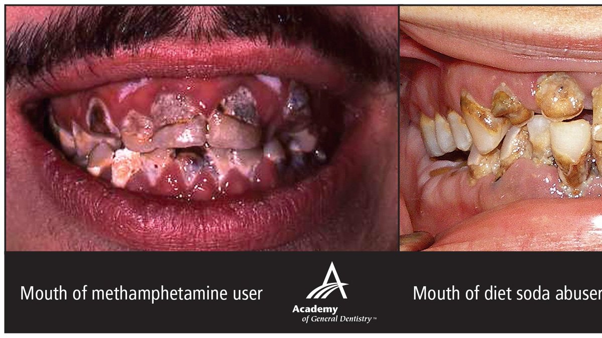 Metamfetamin och lightläsk ger liknande effekter på dina tänder.
