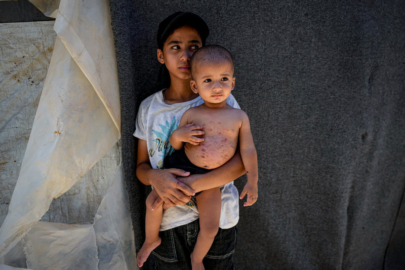Mohammad Abu Obaid, ett av många palestinska barn som fått hudproblem i de överfulla tältlägren, med sin syster i Dayr al-Balah i slutet på juli.