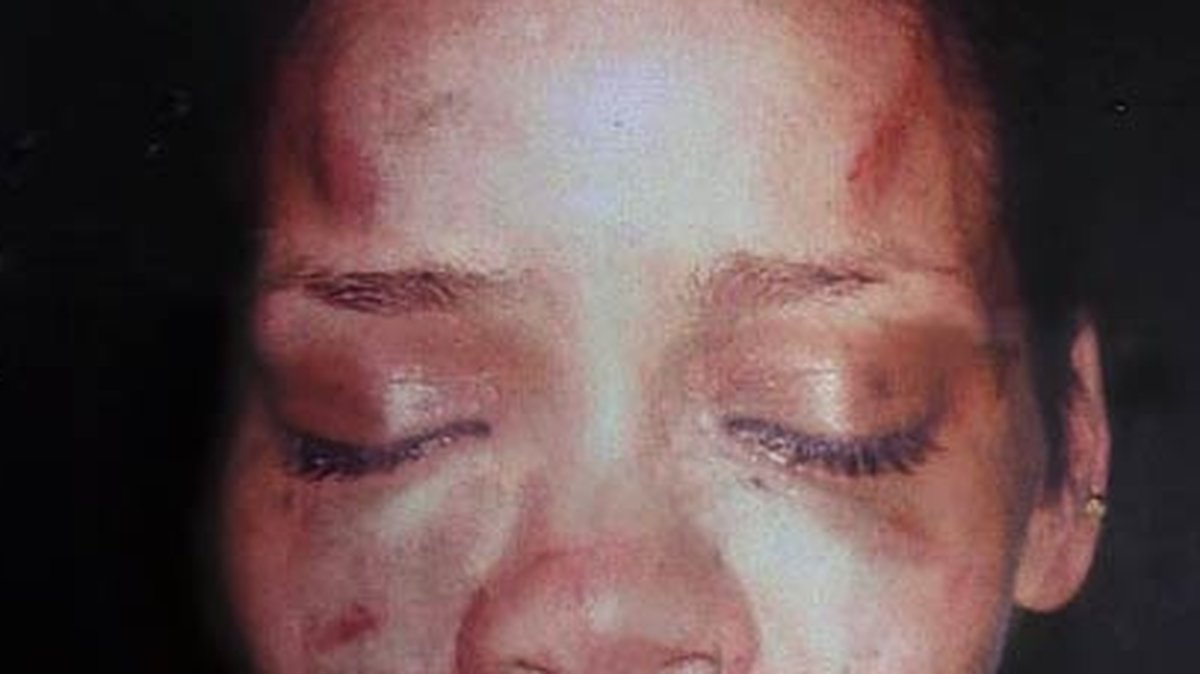Rihannas ansikte efter misshandeln. 
