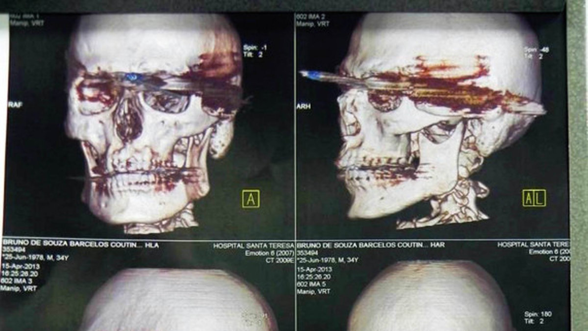 Röntgenbilder från när spetsen fortfarande satt i mannens huvud.