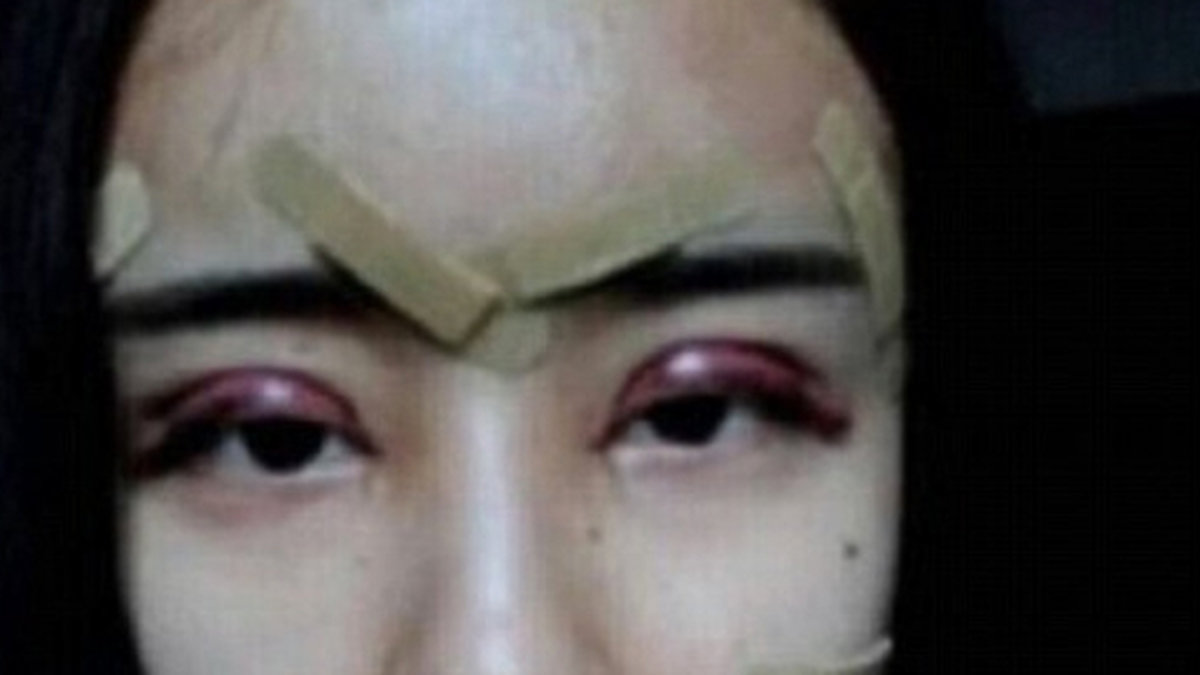 Lee Hee Danae visar sitt ansikte efter att hon har genomgått en rad operationer.