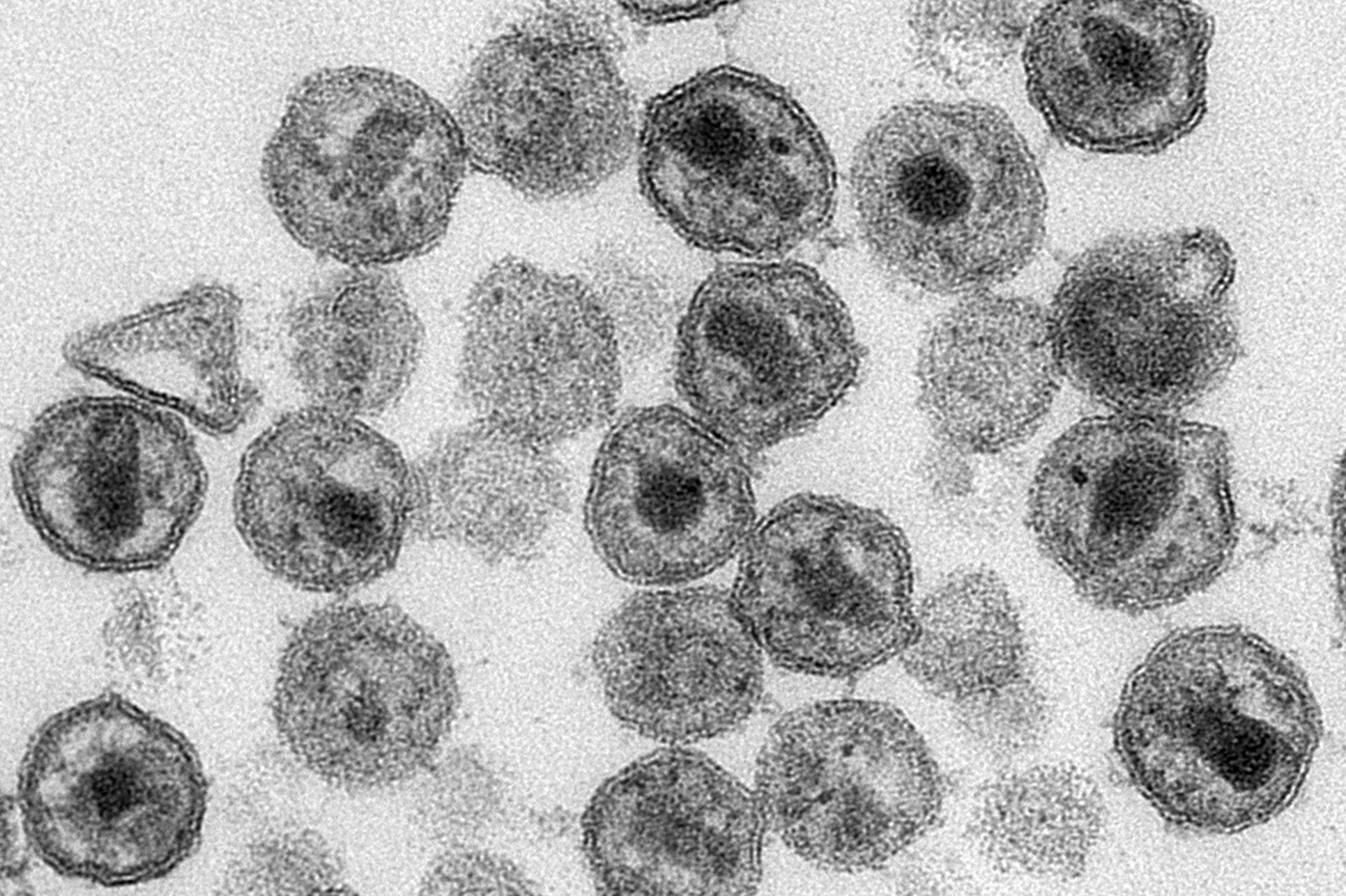 HIV HIV