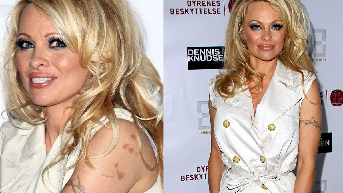 Pamela Anderson tatuerade taggtråd rund överarmen – och gjorde missen att dela tatueringsnål med sin dåvarande kille Tommy Lee. Pamela blev infekterad med Hepatit C efter det missödet.