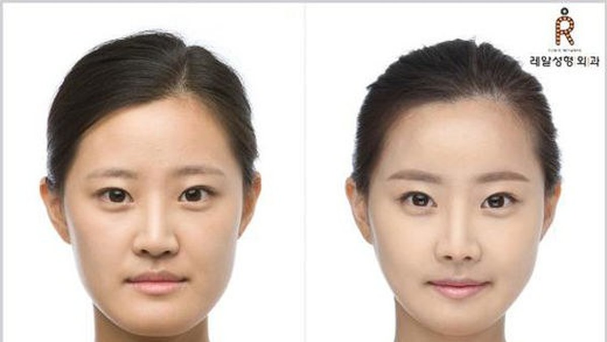 En före- och efterbild visar på Sydkoreas skicklinghet i plastikkirurgi. Klicka vidare för att se deltagarna i Miss Korea 2013.