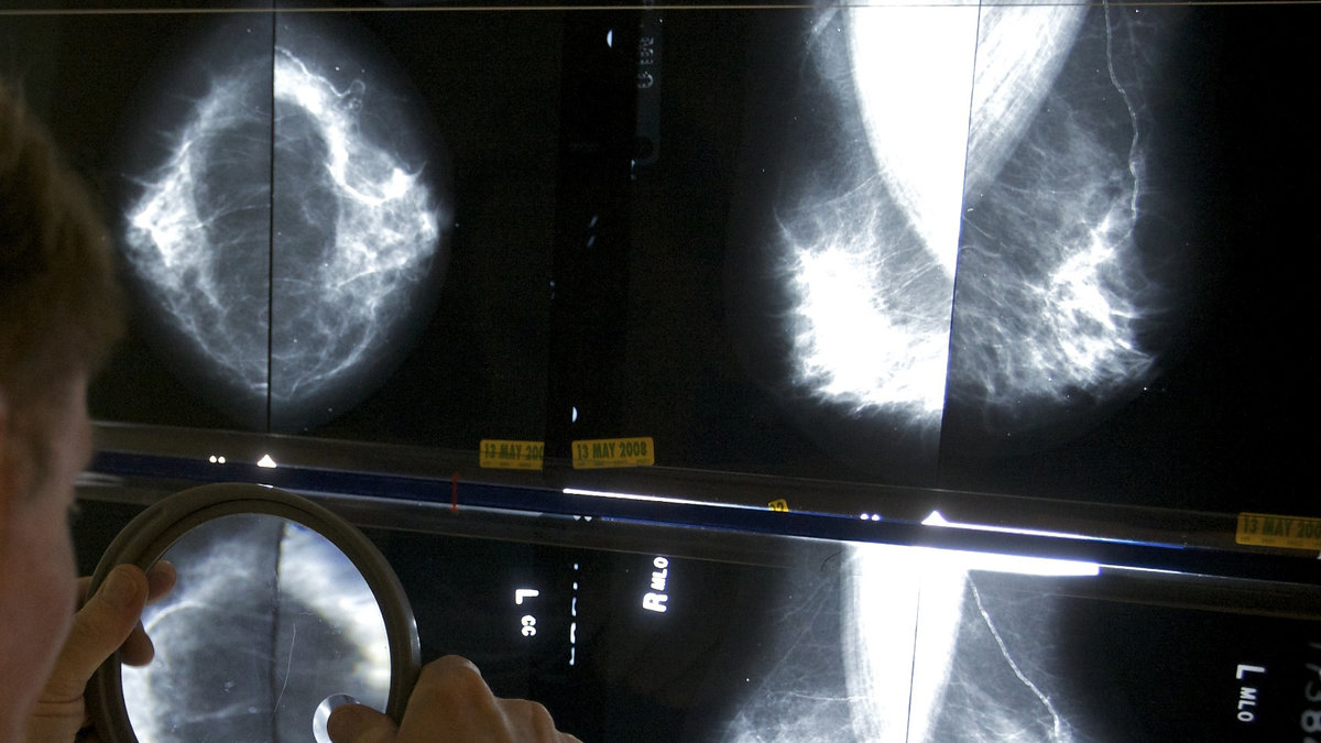 Läkaren letar efter tumörer efter ett mammografibesök.