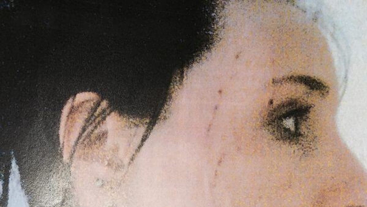 Bild på Camillas skador, polisen trodde hon hade gjort dem på sig själv. 