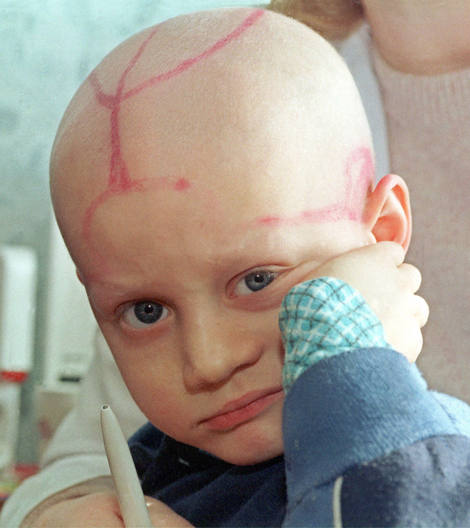 Många av de barn som föddes efter katastrofen har drabbats av cancer. Den här femårige pojken på ett vitryskt sjukhus har leukemi.
