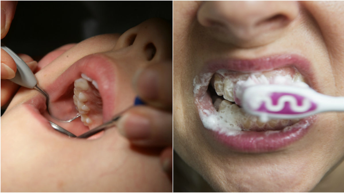 Om man inte tar hand om tänderna kan de drabbas av erosion