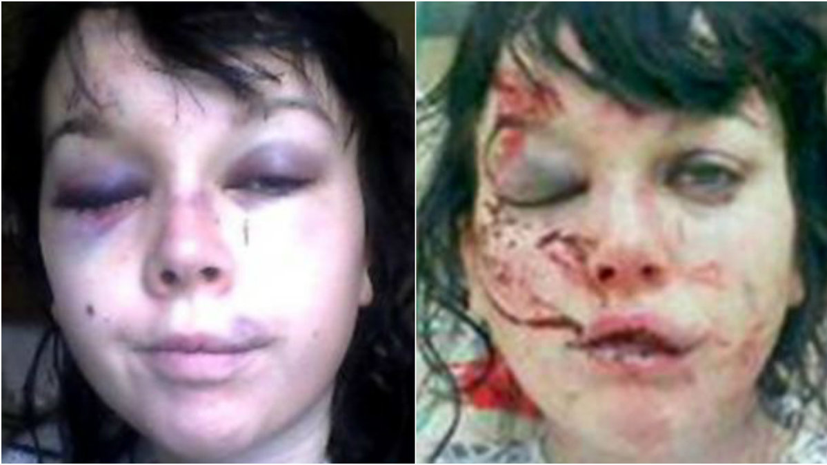 Flickvännens ansikte direkt efter misshandeln (till höger) och några dagar efteråt (til vänster).