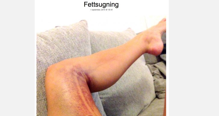 efter fettsugning lår efter fettsugning lår