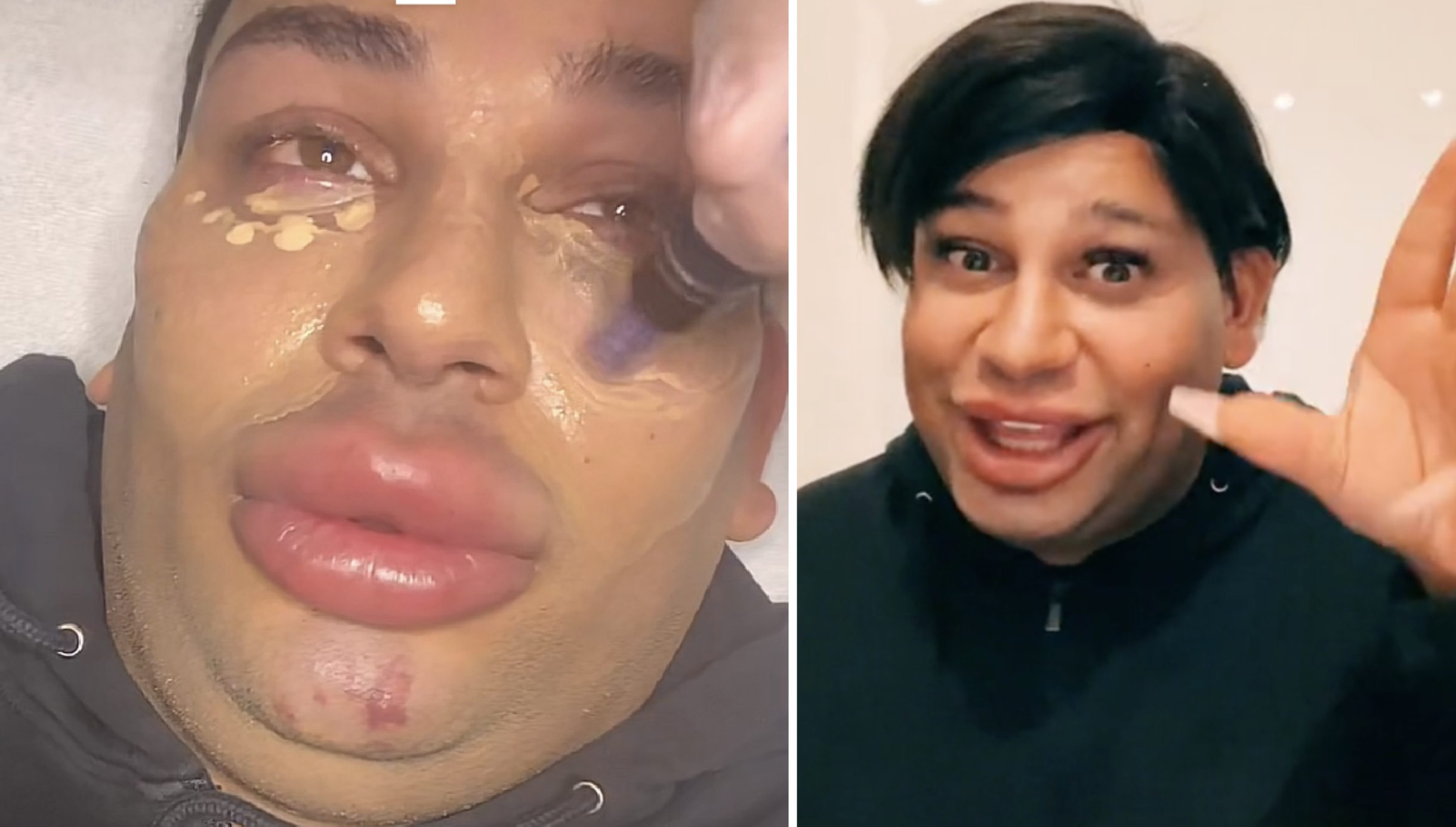 Här gör TiktokJonas, 23, ovanliga skönhetsingreppet