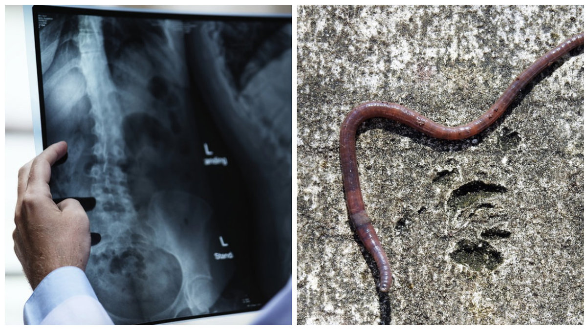 En 35-årig fransk kvinna hade en parasit i ryggraden. 