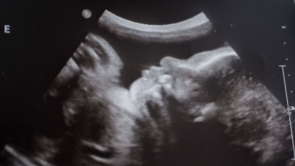 Så här kan ett ultraljud se ut senare i graviditeten. 