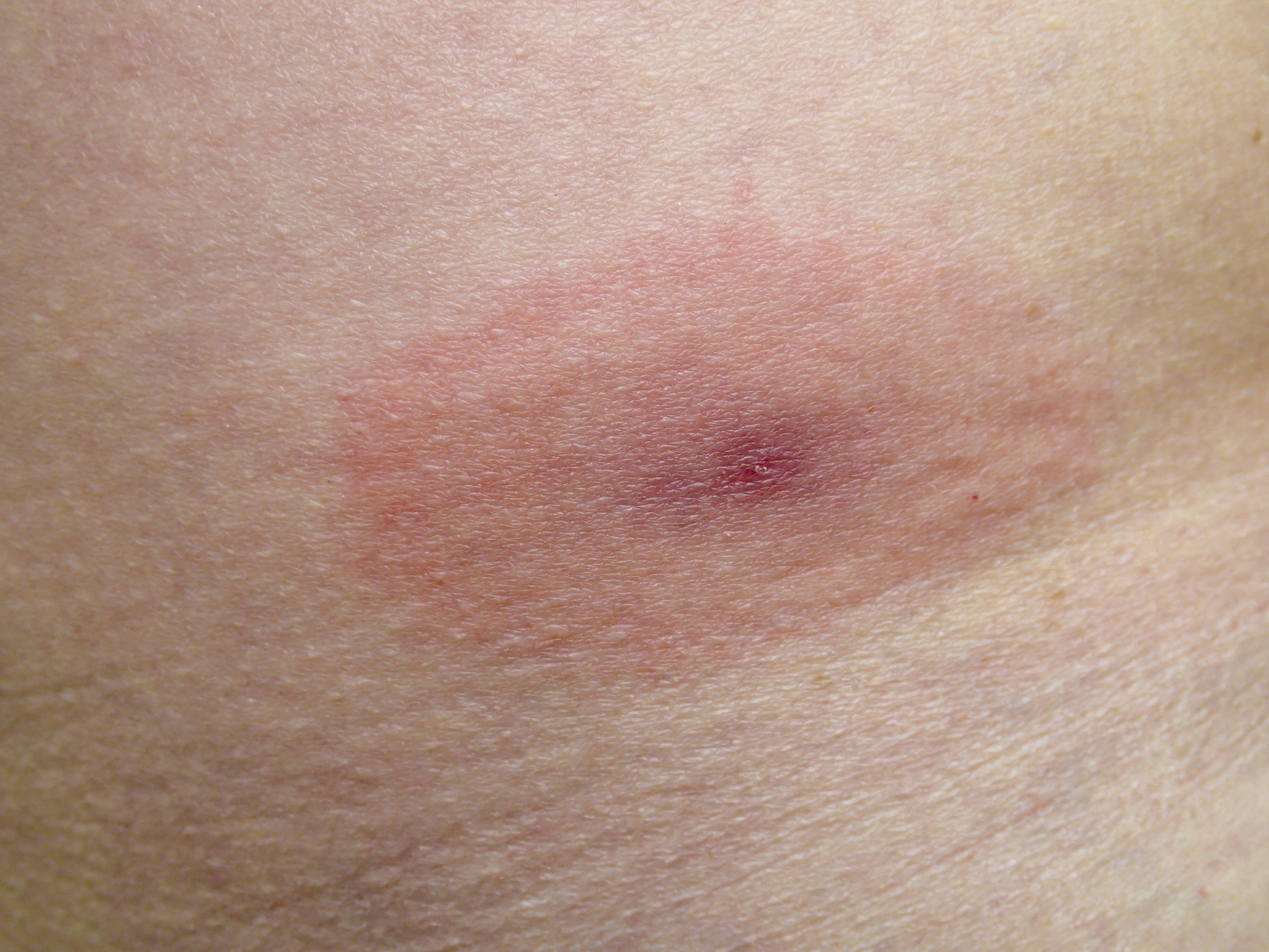 Hudrodnad vid borrelia Hudrodnad vid borrelia