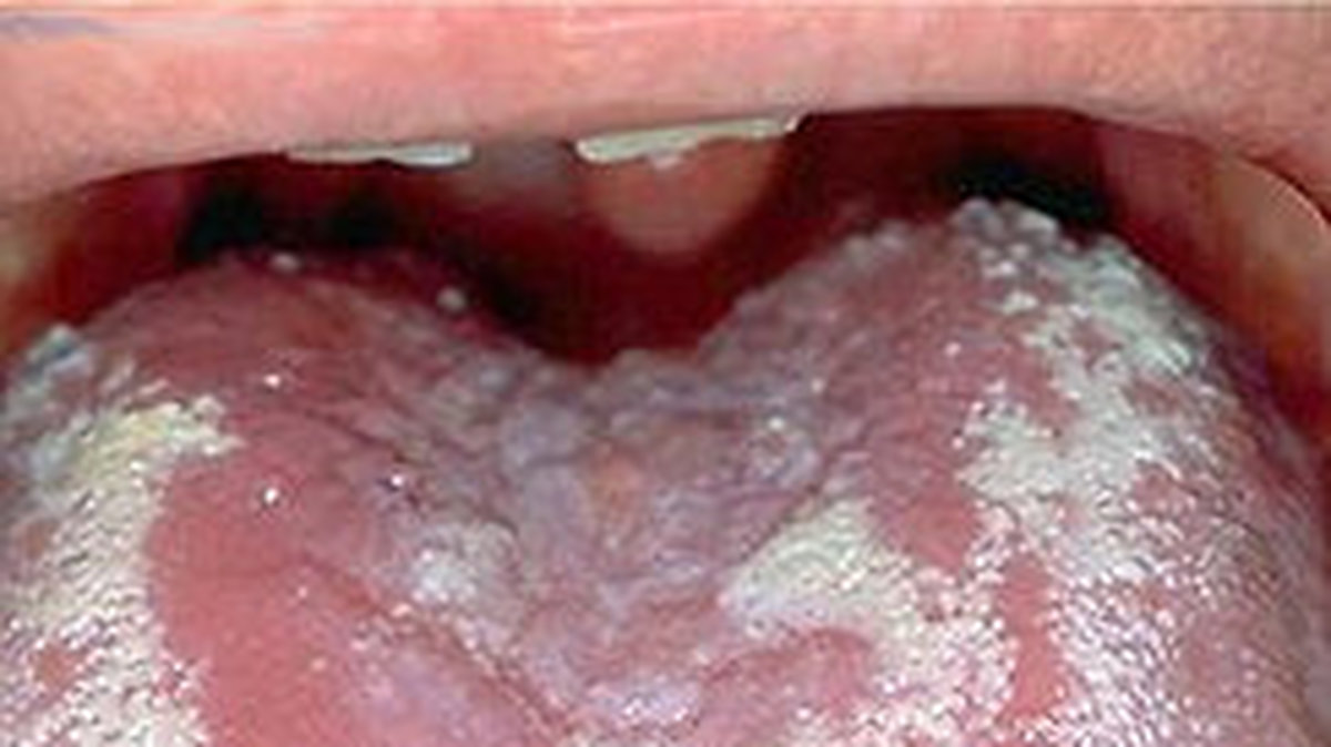 En sådan här tunga kan man få på grund av mat, stress, kemikalier, och hormonella förändringar. 