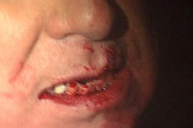 Den 13 december 2009 attackerades han av en sinnessjuk man som kastade en metallmodell av Milanos domkyrka i nyllet på honom. Den 13 december 2009 attackerades han av en sinnessjuk man som kastade en metallmodell av Milanos domkyrka i nyllet på honom.