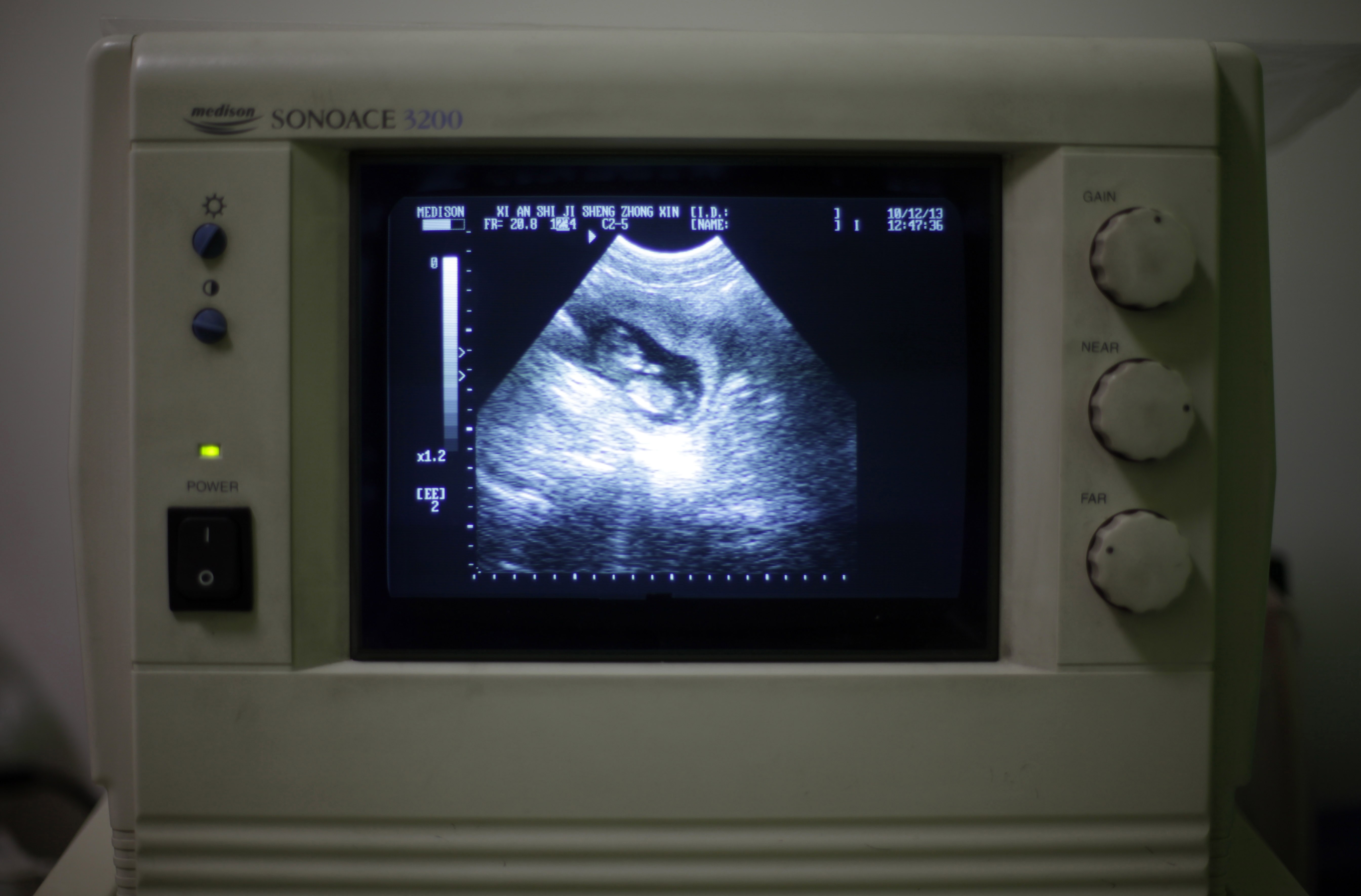 För en kvinna visade de två första ultraljudsundersökningarna att hon fått missfall - men på de tredje syntes hennes barn som hon sedermera födde.