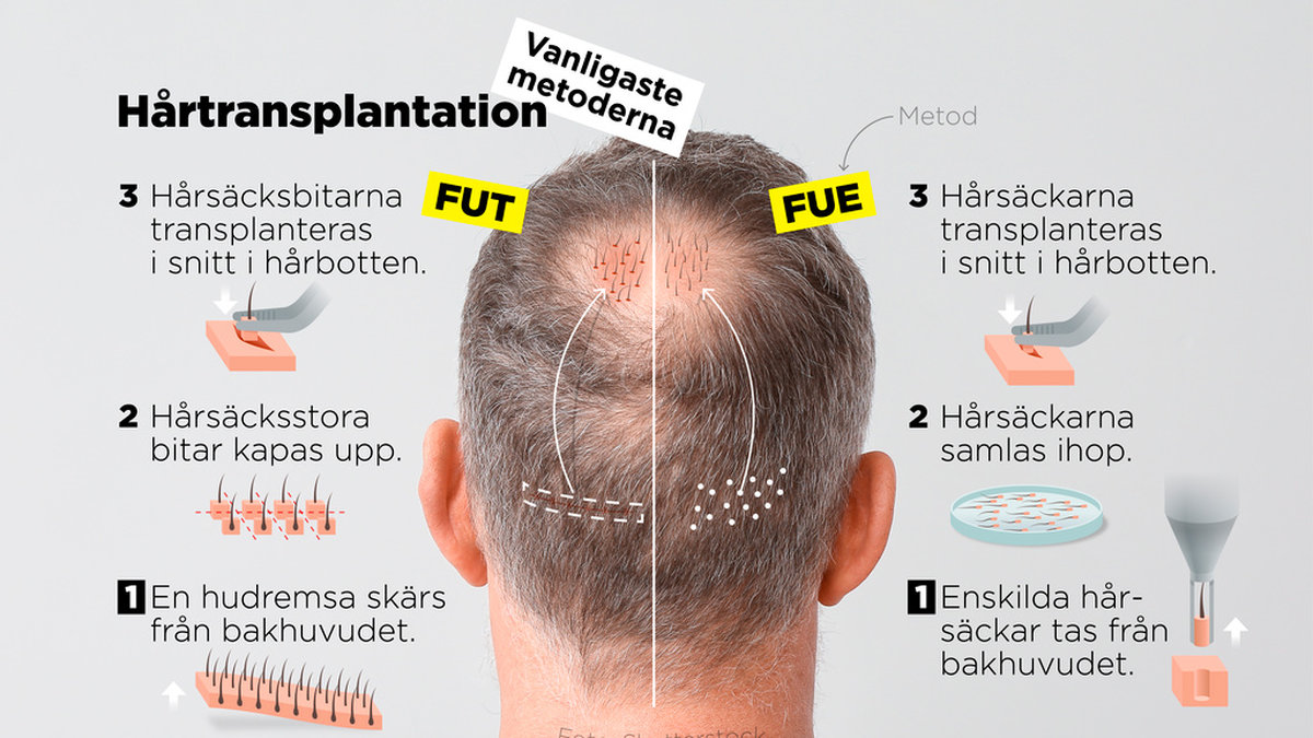 De vanligaste metoderna för hårtransplantation, FUT och FUE.
